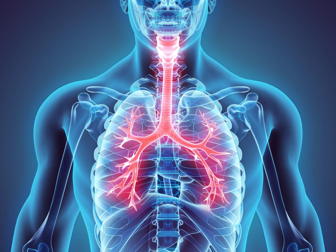 Illustration showing the lungs affected by bronchopneumonia.